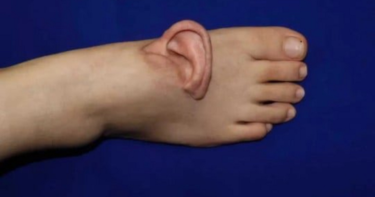 Leszakadt egy nő füle, a lábfejére műtötték, hogy megmentsék