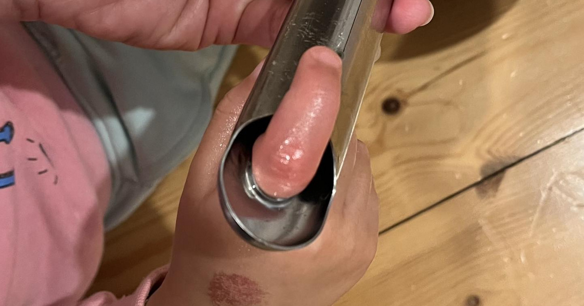 Bedugta ujját a serpenyő nyelén lévő lyukba egy gyermek, a traumatológián végezte