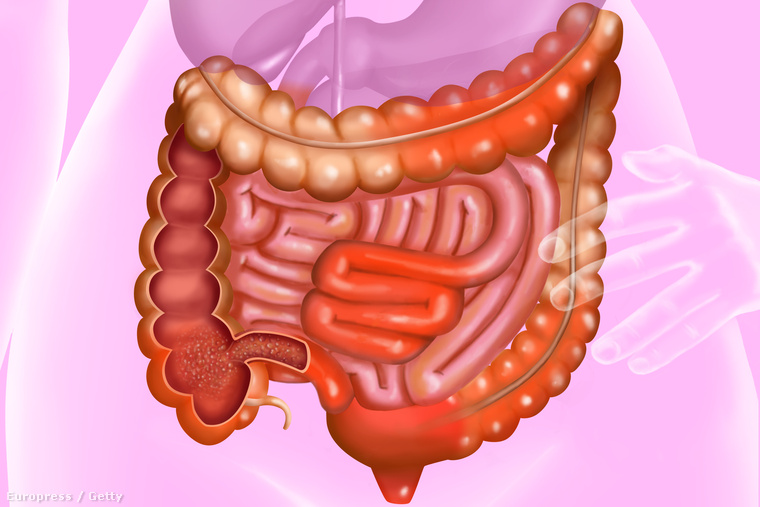 A Crohn-kór egy részleges bélgyulladás, a gyulladásos betegségek (inflammatory bowel disease - IBD) egy típusa, ami a tápcsatornától a szájon át a végbélig terjedhet