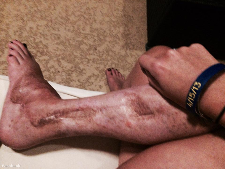 Így nézett ki DiMartiono lába több műtét után is