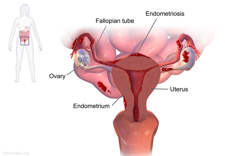 ízületek endometriosis