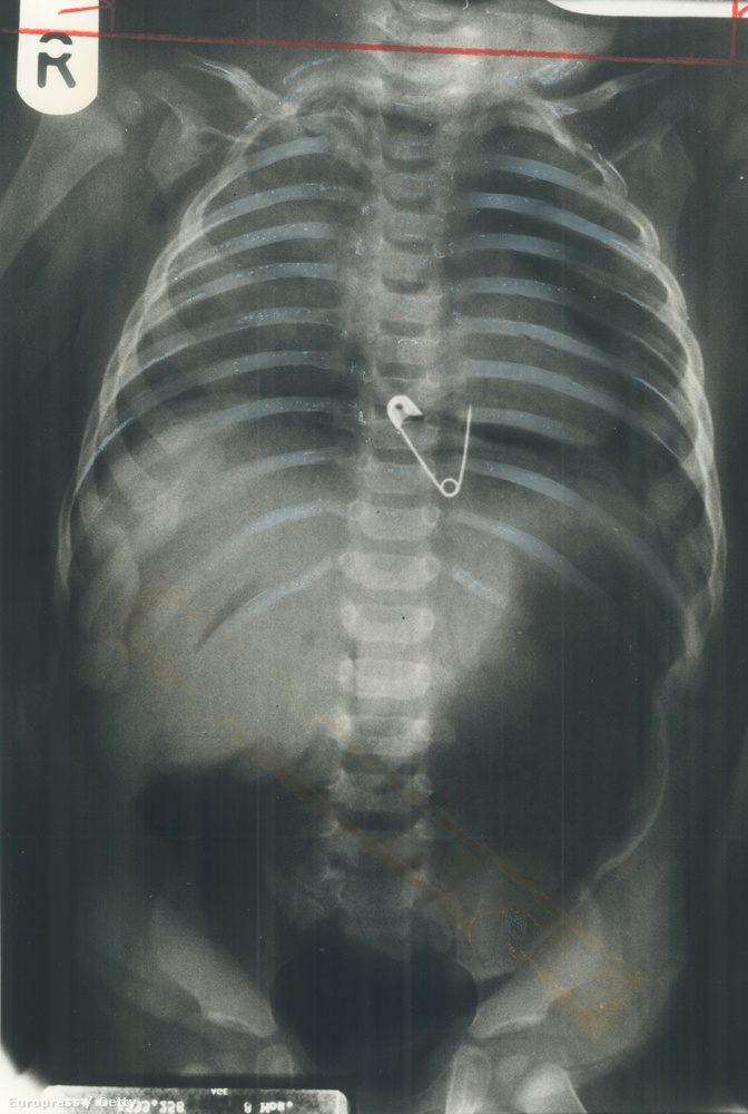 Ezt a röntgent egy 8 hónapos kisfiúról, bizonyos Andrew Knightonról készítették