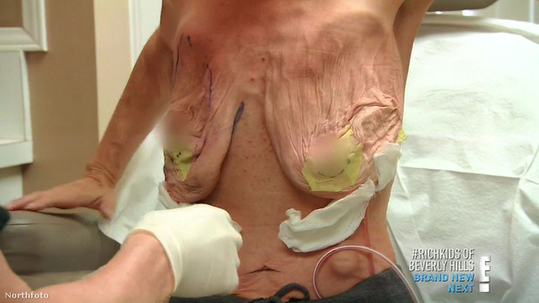 Így néz ki egy hatalmas implantátumoktól megszabadított mell